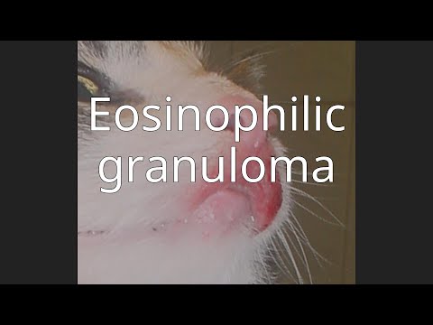 Eosinophilic granuloma