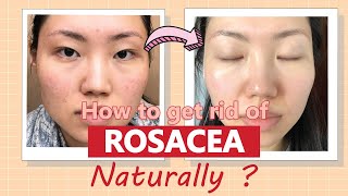 Recover from Acne Rosacea without medicine or laser | no more flushing | Natural Remedies