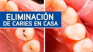 No importa cuántas caries tengas, No se pueden eliminar desde casa fácilmente / Odontoespecialistas