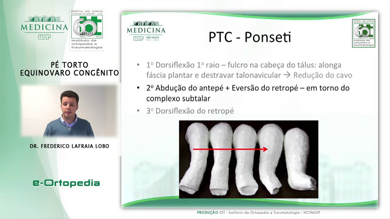 Pé Torto Equinovaro Congênito- Dr. Frederico Lafraia Lobo