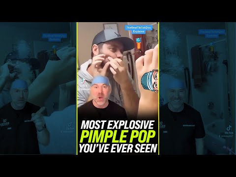 Most Explosive Pimple Pop You’ve Ever Seen 💥 #shorts