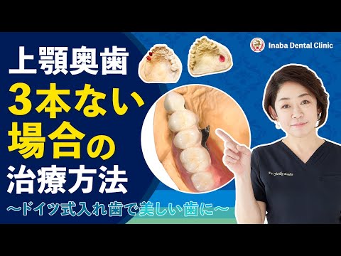 上顎奥歯3本ない場合の治療方法〜ドイツ式入れ歯で美しい歯に〜