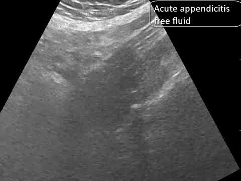 Acute Appendicitis - Free Fluid in USG