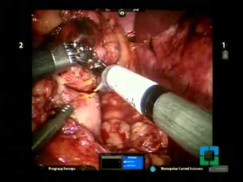 Robot Assisted Laparoscopic Partial Nephrectomy - Step by Step Contemporary Technique