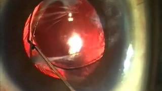 Difficult Cases:  Dislocated Lens with Phimosis