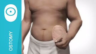 Product video: ActiveLife One-Piece Drainable Pouch with Stomahesive Skin Barrier