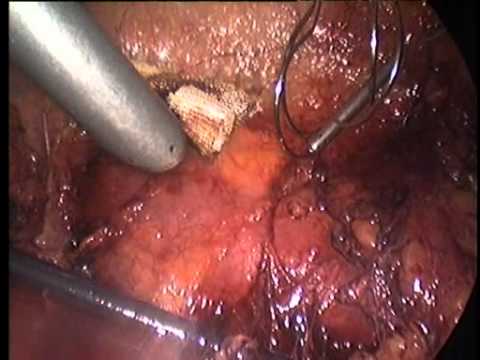 Kidney-Preserving Renal Cell Cancer Resection - Endoscopy 