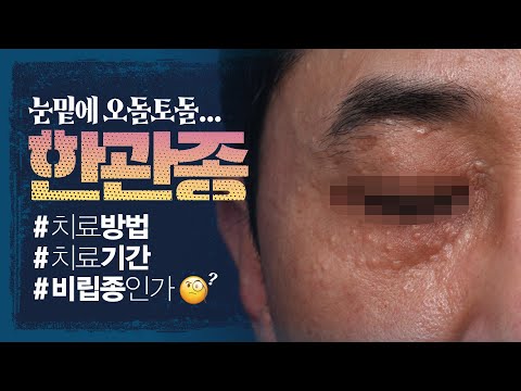 한관종 치료방법, 치료기간? 이효리도 걸렸던 한관종, 어떻게 해야 없앨 수 있을까?