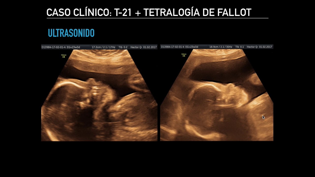 Caso Clínico: Síndrome de Down asociado de Tetralogía de Fallot