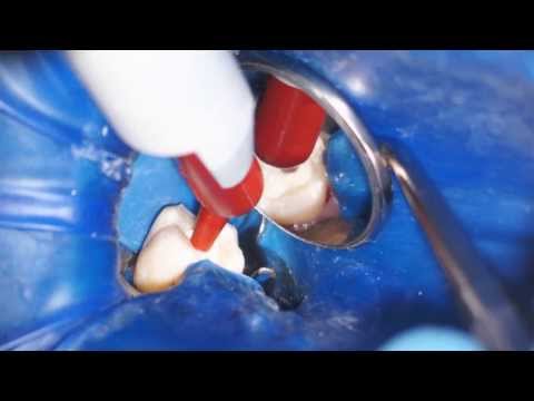 Using Temporary Restorative Material - Dr. Scott Norton