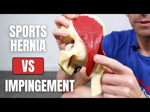 Hip Impingement vs Sports Hernia - What's the Difference?