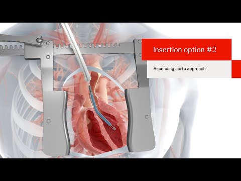 Impella 5.5 with SmartAssist (Gen 2) Product Animation
