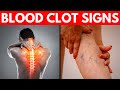 13 Warning Signs Of Blood Clot Mostly Ignored