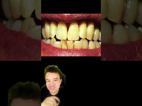 The secret to not having yellow teeth #shorts