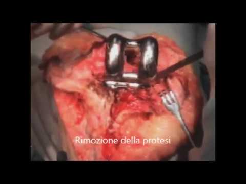 Ricette zenzero per giunti Sanatorio per il trattamento dei giunti in Azerbaigian
