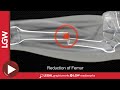 Midshaft Femur Fracture Intramedullary Nailing 3D Animation