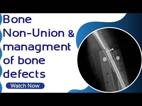 Bone Non-Union & Managment of Bone Defects