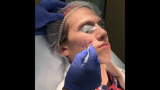 Treatment of Rolling Acne Scars