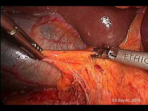 Laparoscopic D2 Partial Gastrectomy