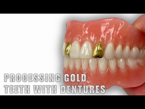Processing Gold Teeth with Dentures
