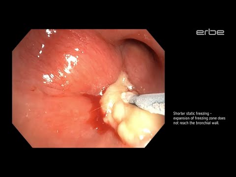 Cryoextraction of large mucous plug using ERBECRYO® 2 with 1.1mm cryroprobe