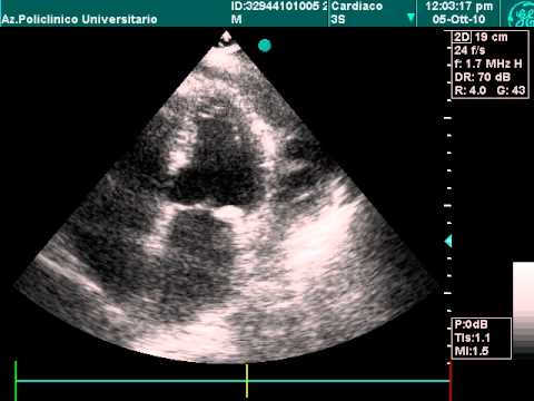 Pericardial Effusion In Echocardiography Examination