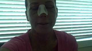My Facial Plastic Surgery Blog – Recovery Day 14