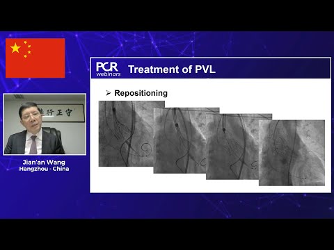 Transcatheter heart valve sizing in challenging aortic anatomies: experiences from Europe and China