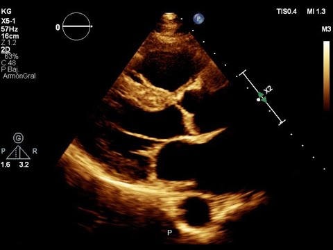 Anatomia ecocardiografica