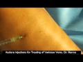 Varicose Vein Removal with Asclera Injections ...