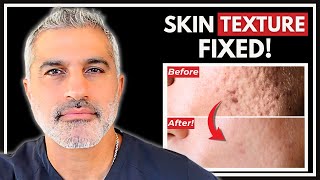 How to Treat Skin Texture & Acne Scars - What Actually Works