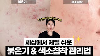 여드름의 흔적! 붉은기 & 색소침착 관리 이것만 딱 합시다!😎 세상에서 제일 쉬운 관리법 ep.3