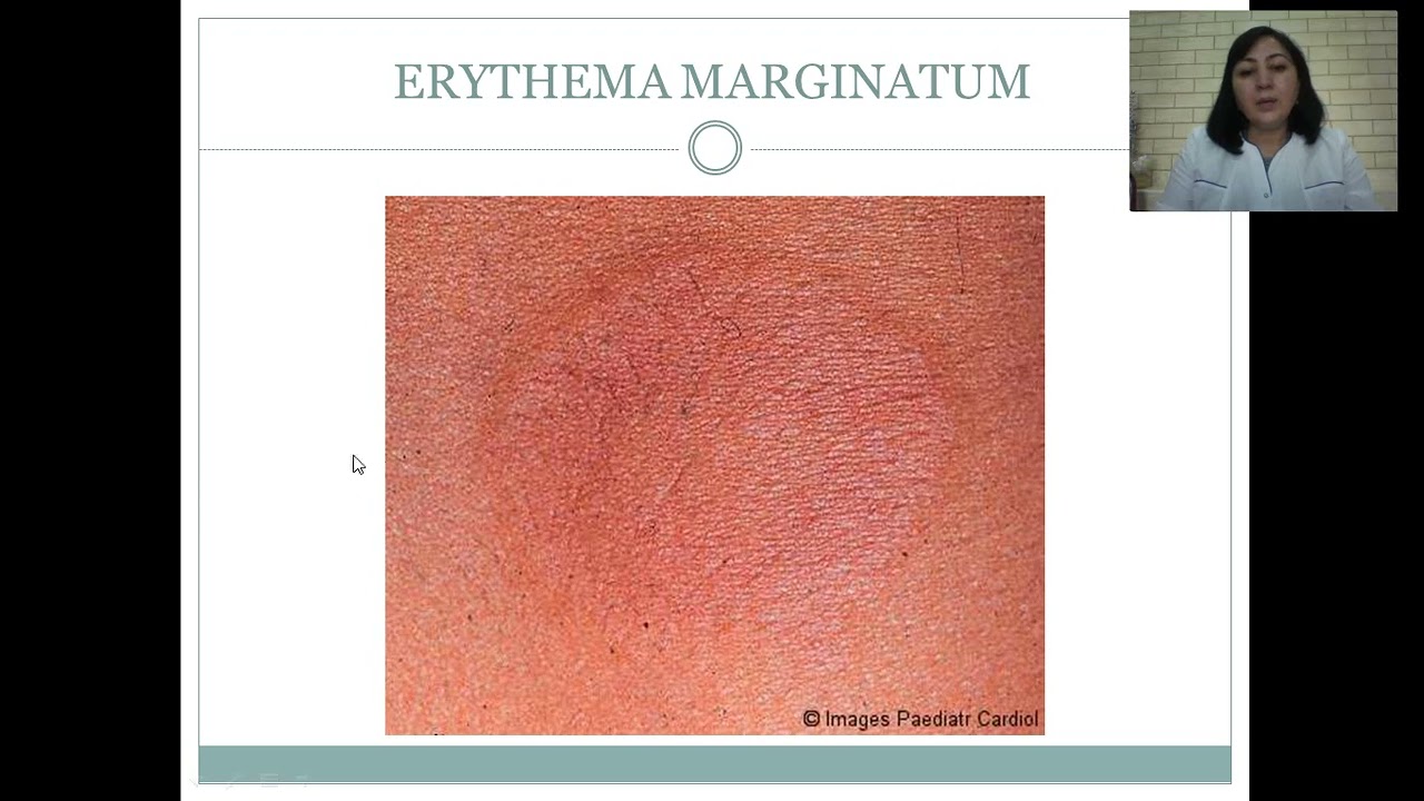 Acute rheumatic fever