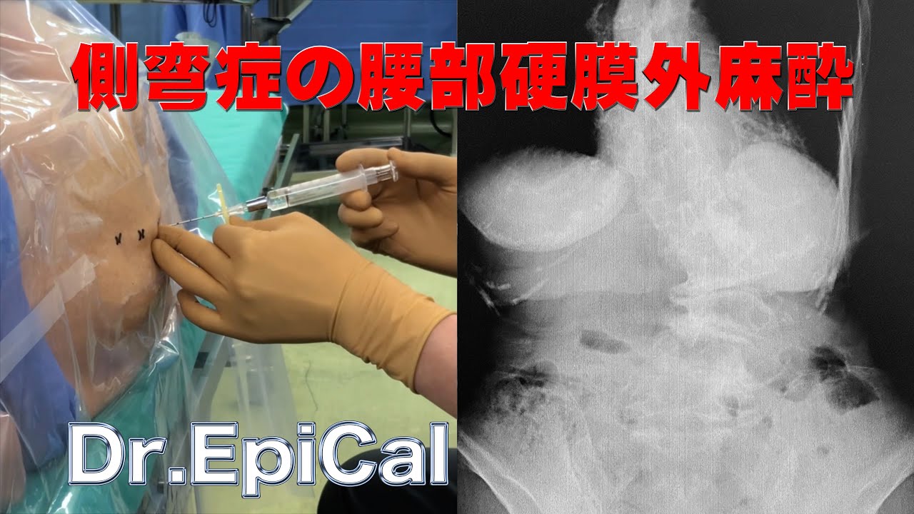 側弯症の腰部硬膜外麻酔 epidural anesthesia by Dr.EpiCal