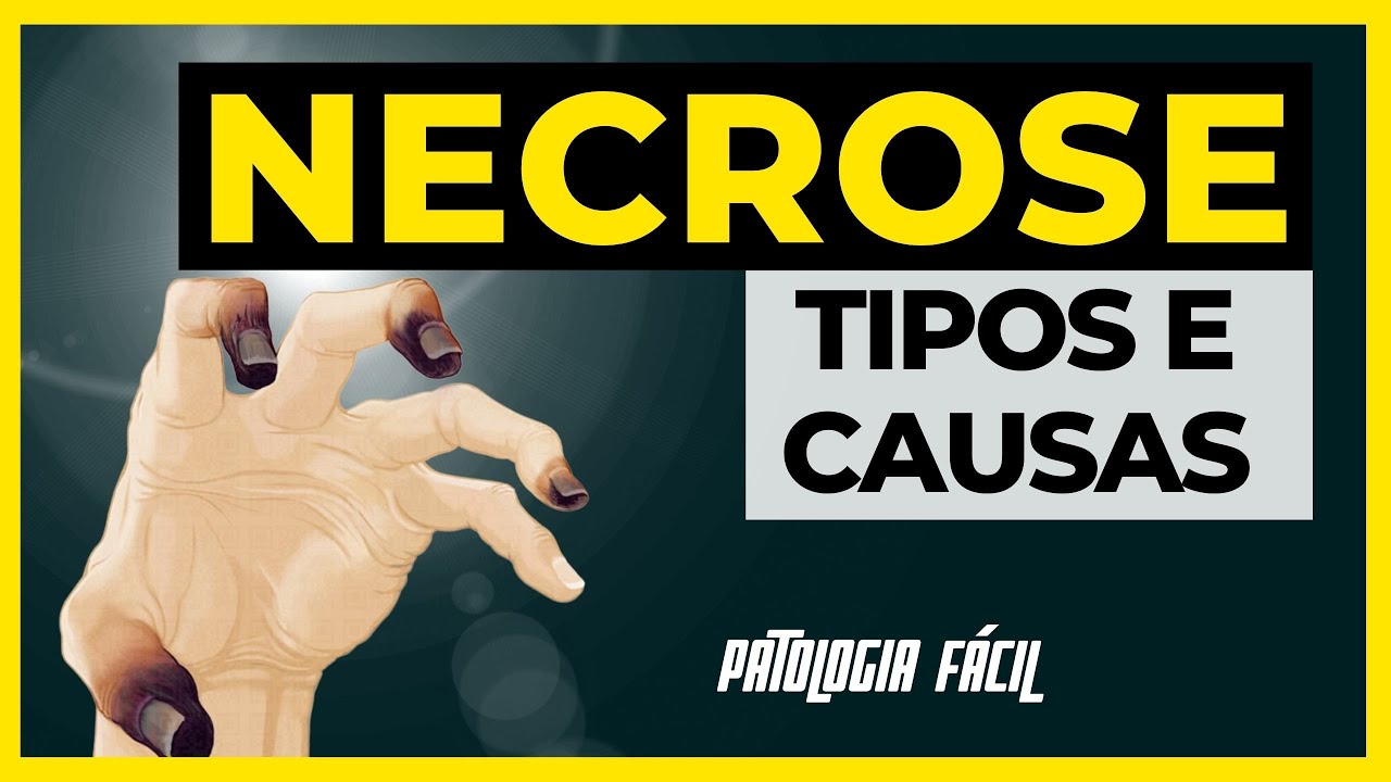 Necrose Patologia: Coagulação, Liquefação, Caseosa, Gangrenosa, Gordurosa