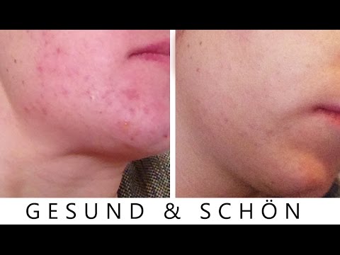 Prävention für Menschen mit einer Prädisposition für Diabetes Wie und wann zu injizieren Insulin