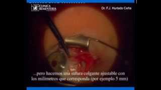 Cirugía de Estrabismo con anestesia tópica | Dr. F.J. Hurtado | Clínica Rementería
