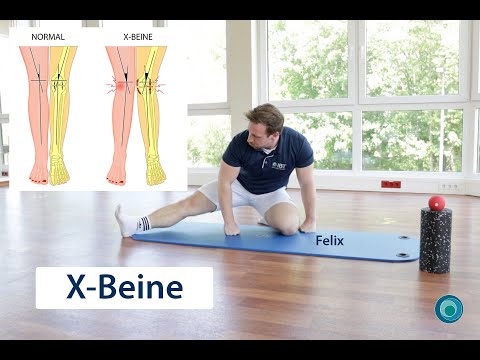 Exercises for the symptom: X-legs (genu valgum) | with Felix