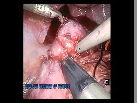 Laparoscopic Partial Nephrectomy in Horseshoe Kidney