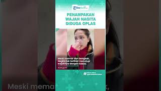 Wajah Terlihat Bengkak dan Memar, Nagita Slavina Dituding Jalani Operasi Plastik di Korea Selatan