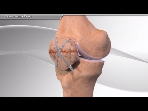 Patella Fracture Repair