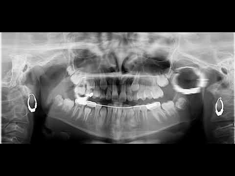 Can You Determine The Patient's Age On Panoramic Radiograph?
