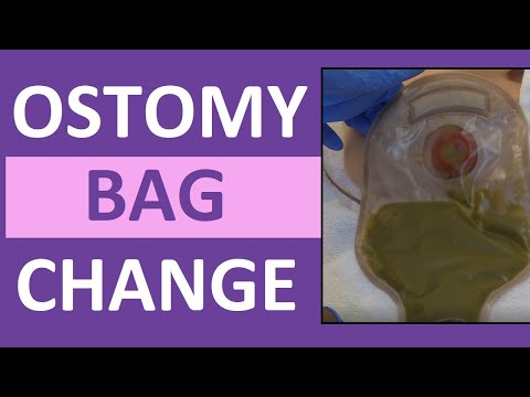 Ostomy Bag Pouch Change | Ostomy Care Nursing | Colostomy, Ileostomy Bag  Change