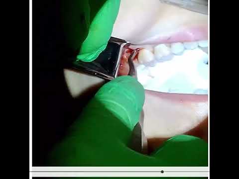 VeeCare 77R Surgical Elevator