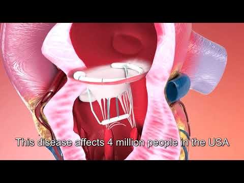 InnerCore-Medical - MVC Plus Device