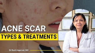 Acne scars treatment | Acne scars before and after | Acne Treatment Skincare | Acne treatment