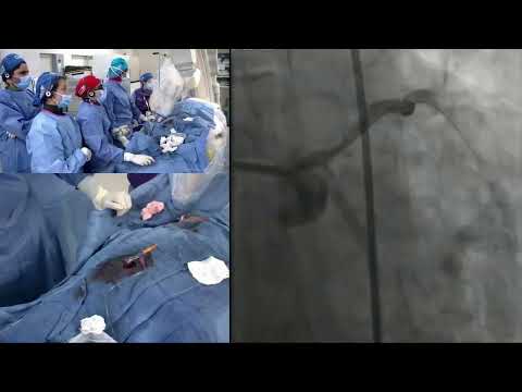 Live Case #8 - Calcific LAD and LCx Disease RotaDes in HD Patient