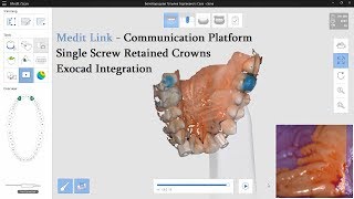 Medit Link + Exocad / Single Temporary Screw Retained Crowns