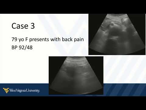 Abdominal POCUS 4 - The Abdominal Aorta