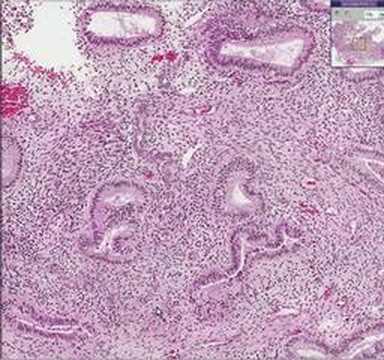 endometrium rák méheltávolítás